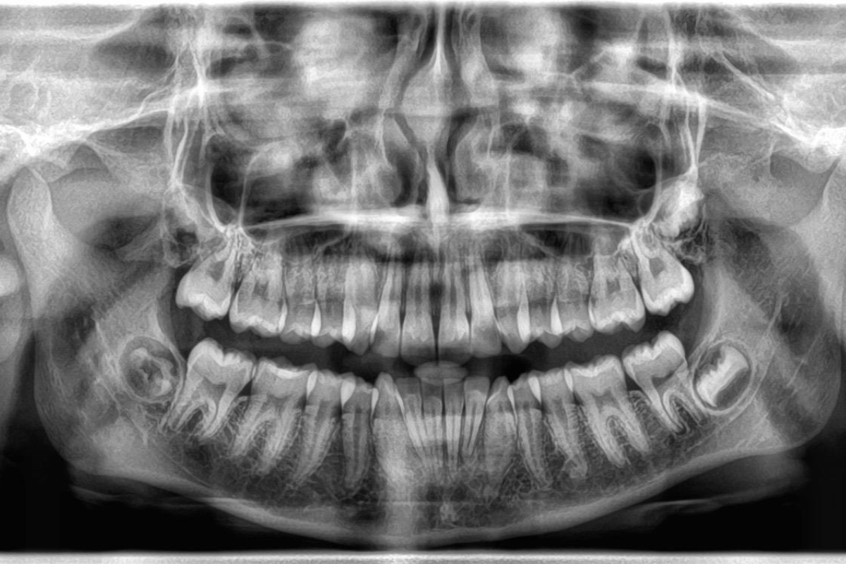 Before Treatment