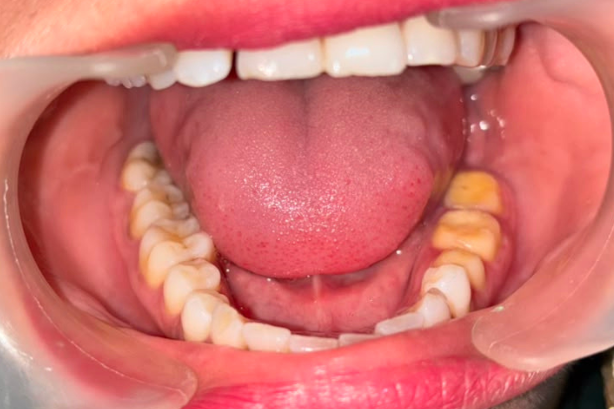 Before Treatment